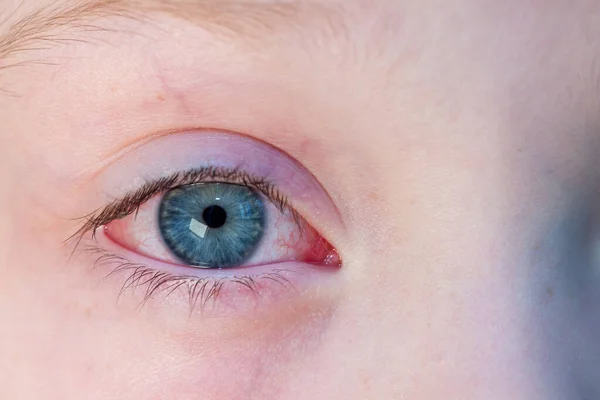 Allergic Conjunctivitis