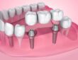 Dental Bridge