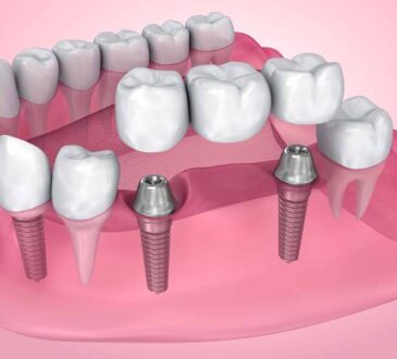 Dental Bridge