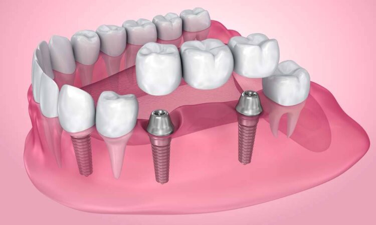 Dental Bridge