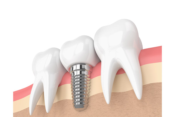 Dental Implant Outcomes