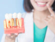 Dental Implant Outcomes