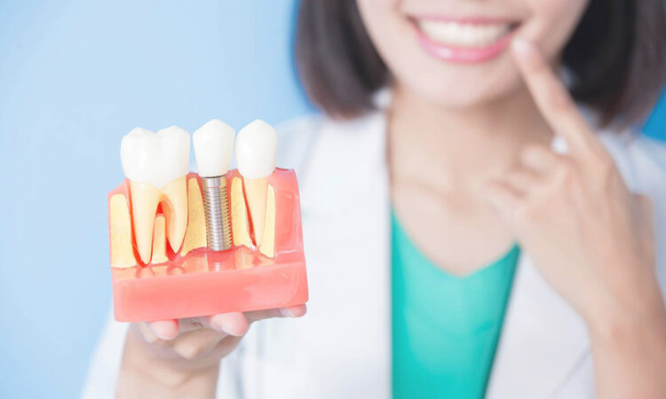 Dental Implant Outcomes