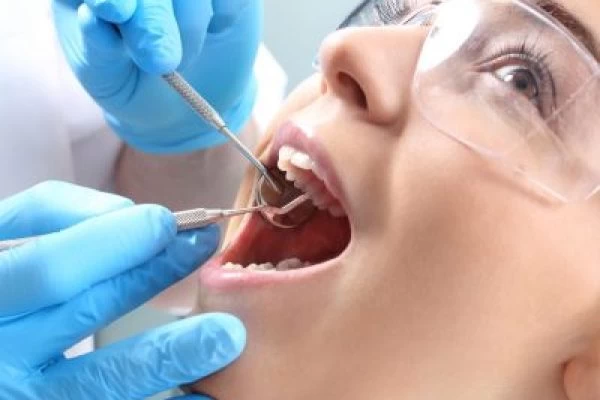 Dental Sealants