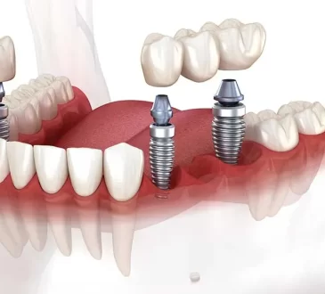 Dental Implants