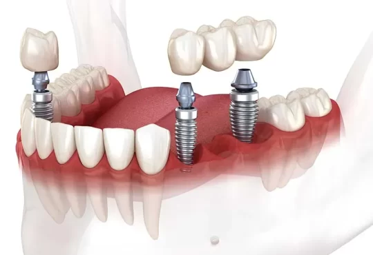 Dental Implants