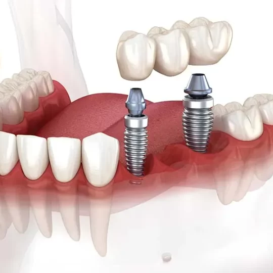 Dental Implants