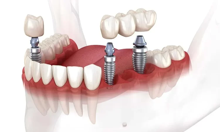 Dental Implants