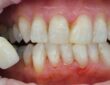 tooth yellowing