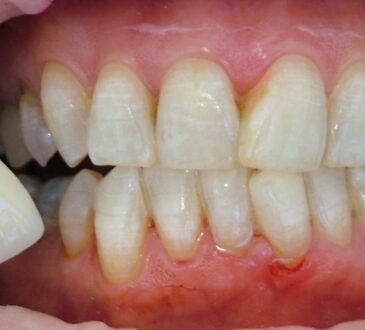 tooth yellowing