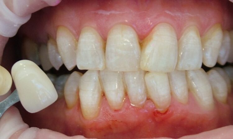 tooth yellowing